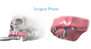 Surgical Phase - Implant Supported Denture
