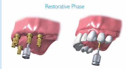 Restorative Phase - Implant Supported Dentures