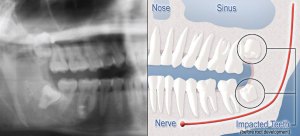 Impacted teeth X-ray